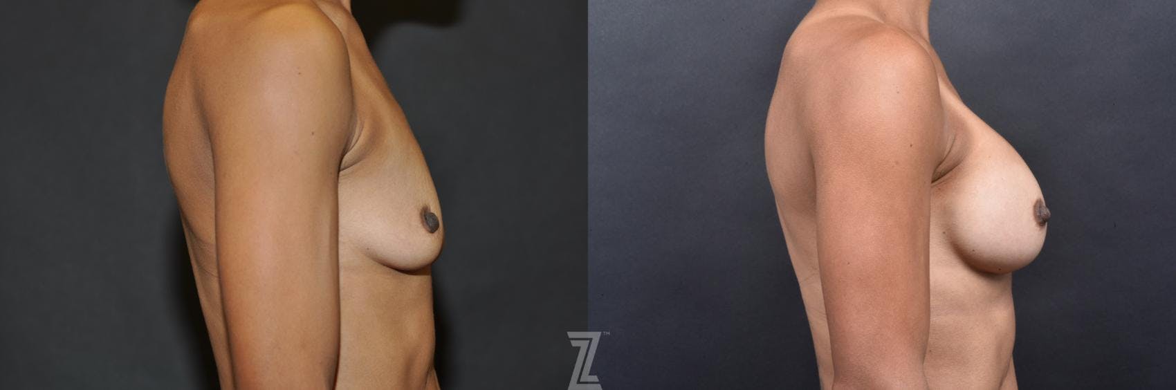 Breast Augmentation Before & After Gallery - Patient 132790659 - Image 5