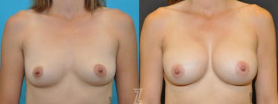 Austin Frontal view before & after images of 38-year-old active mother of three with Silicone Implants with Highly Cohesive Gel (Gummy Bear Implants) - The Piazza Center - The Piazza Center