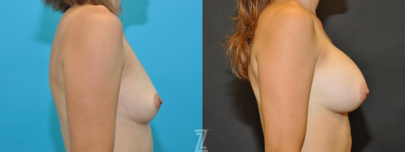 Breast Augmentation Before & After Gallery - Patient 132790666 - Image 5