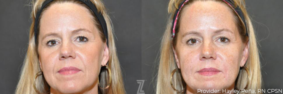 The Age-Defying Benefits of Full Facial Balancing | Piazza Center
