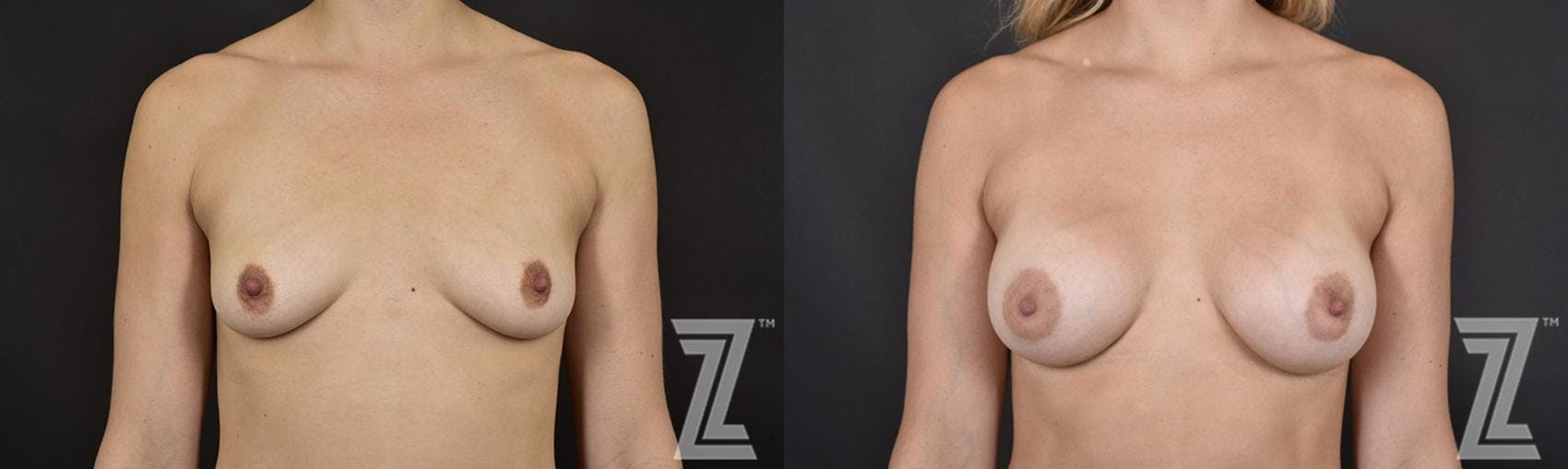 Breast Augmentation Before & After Gallery - Patient 132790670 - Image 1
