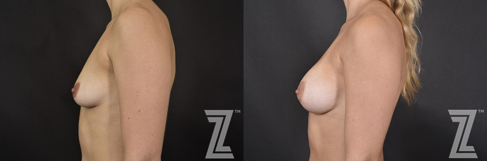 Breast Augmentation Before & After Gallery - Patient 132790670 - Image 3