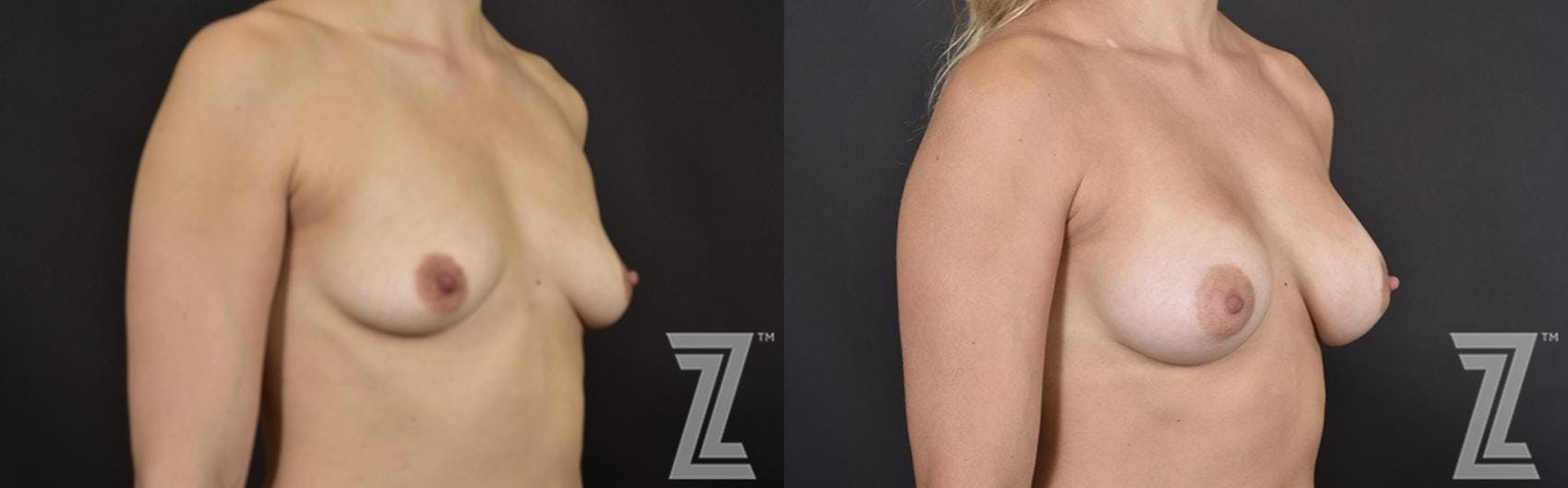 Breast Augmentation Before & After Gallery - Patient 132790670 - Image 4