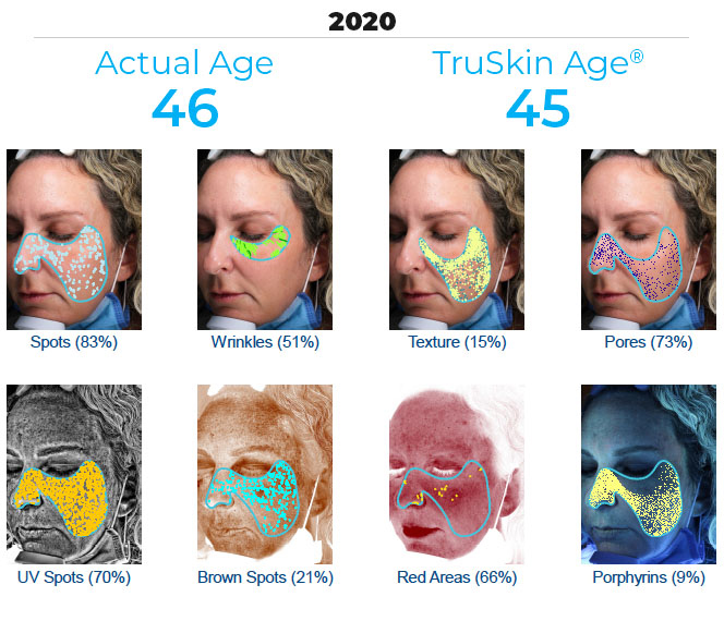 visia skin analysis