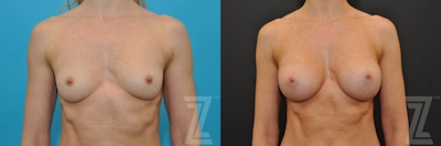 Breast Augmentation Before & After Gallery - Patient 132790678 - Image 1