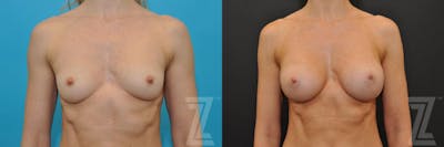 Austin Frontal View before and after of 36 year old woman with Silicone Implants with Highly Cohesive Gel (Gummy Bear Implants) - The Piazza Center - The Piazza Center