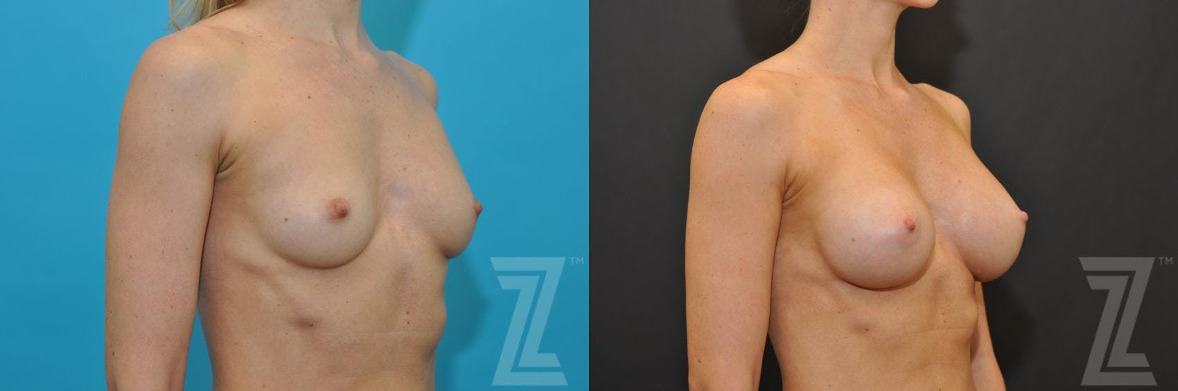 Breast Augmentation Before & After Gallery - Patient 132790678 - Image 4