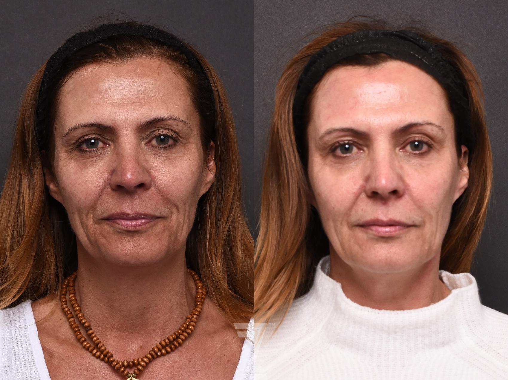 face treatment results