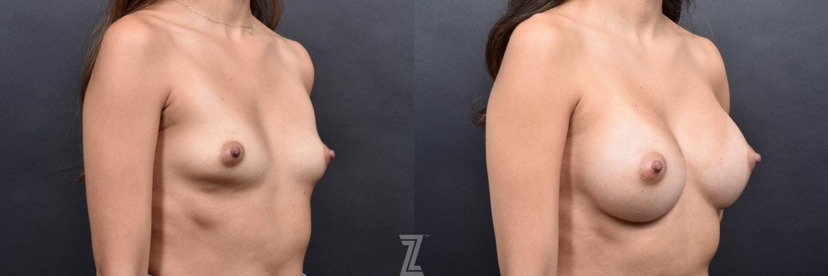 Breast Augmentation Before & After Gallery - Patient 132790682 - Image 4