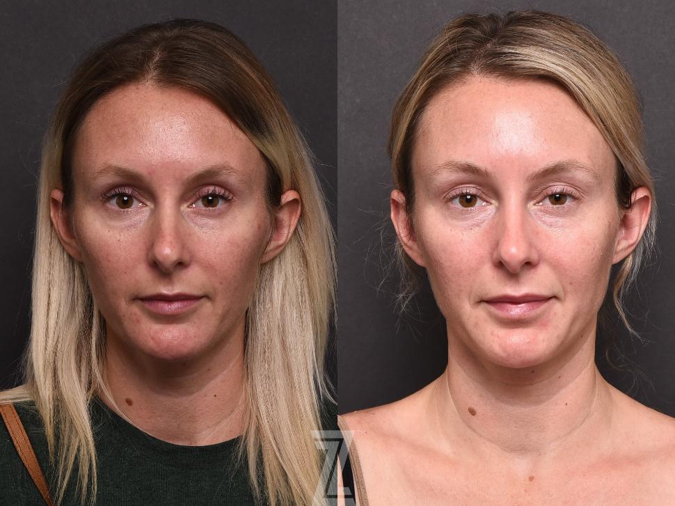 32 year old female, wanted to do a series of BBL laser treatments to help with hyperpigmentation and fine lines.