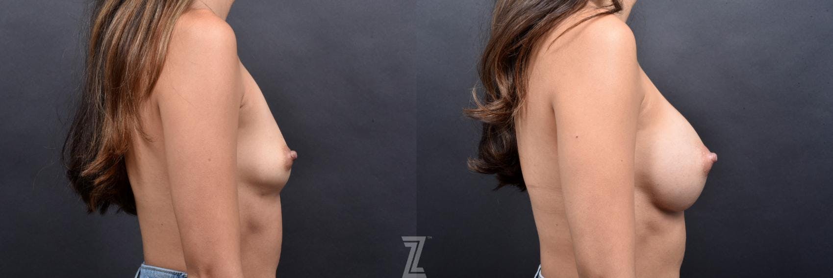 Breast Augmentation Before & After Gallery - Patient 132790682 - Image 5