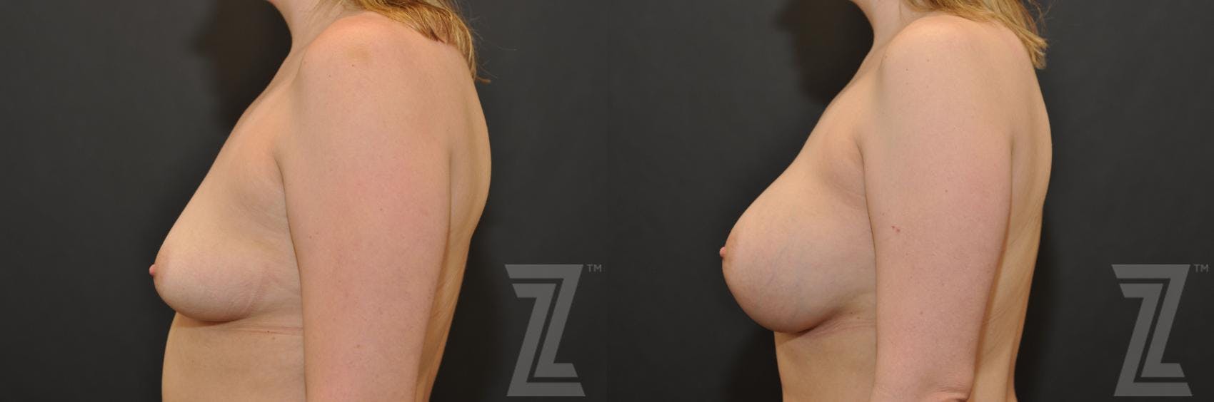 Breast Augmentation Before & After Gallery - Patient 132790689 - Image 3