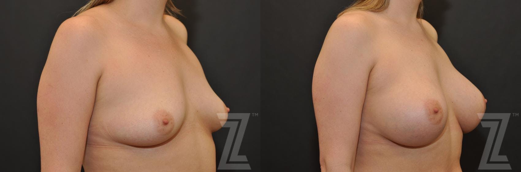 Breast Augmentation Before & After Gallery - Patient 132790689 - Image 4