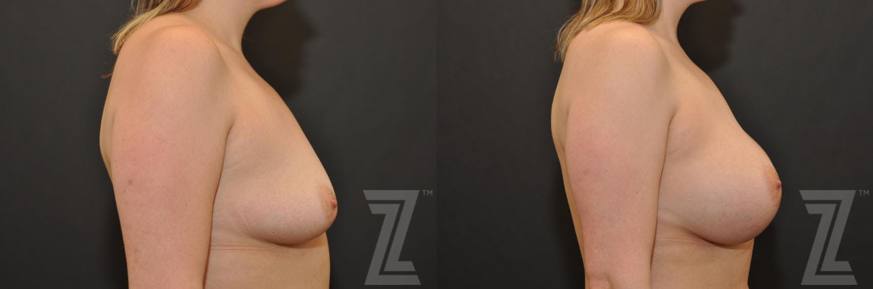 Breast Augmentation Before & After Gallery - Patient 132790689 - Image 5
