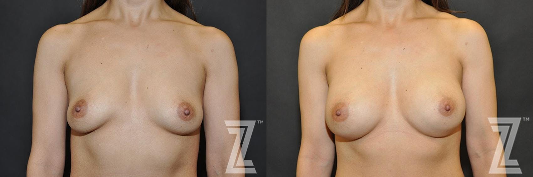 Breast Augmentation Before & After Gallery - Patient 132790695 - Image 1