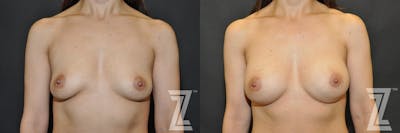 Austin Frontal view of before & after image of 40 year old woman with Silicone Implants with Cohesive Silicone Gel - The Piazza Center