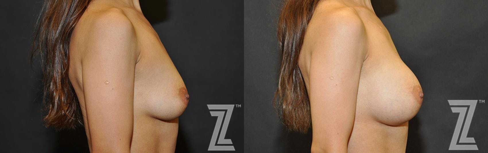 Breast Augmentation Before & After Gallery - Patient 132790695 - Image 5