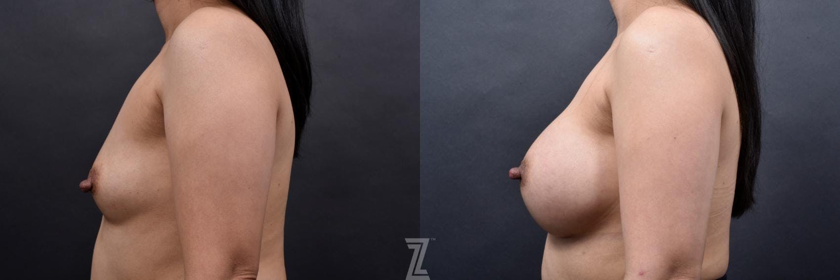 Breast Augmentation Before & After Gallery - Patient 132790696 - Image 3