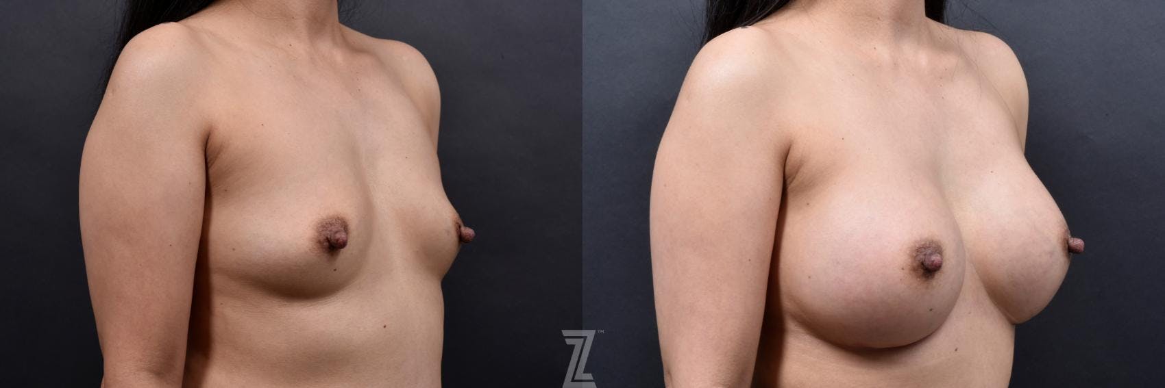 Breast Augmentation Before & After Gallery - Patient 132790696 - Image 4