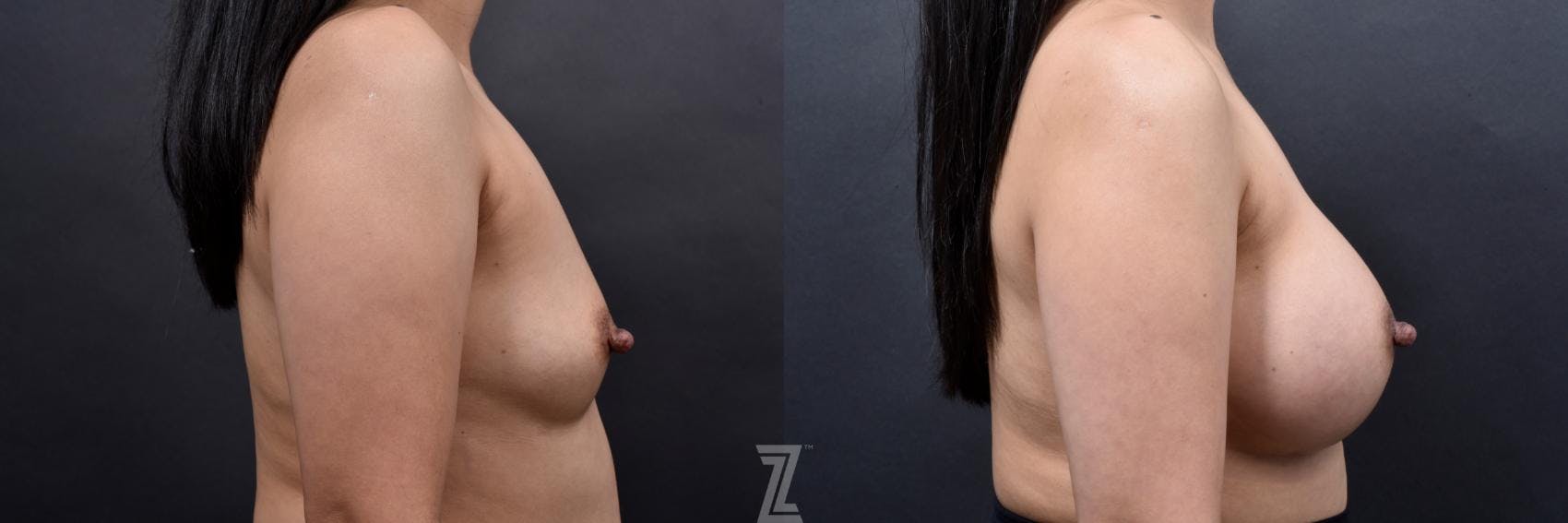 Breast Augmentation Before & After Gallery - Patient 132790696 - Image 5