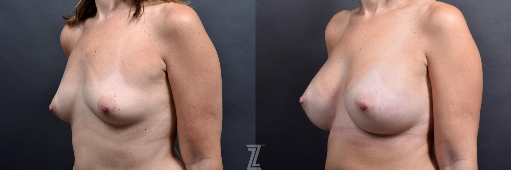 Breast Augmentation Before & After Gallery - Patient 132790698 - Image 2