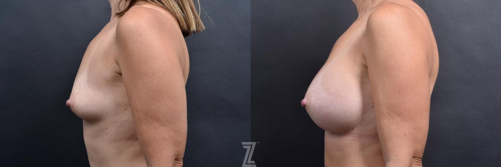 Breast Augmentation Before & After Gallery - Patient 132790698 - Image 3