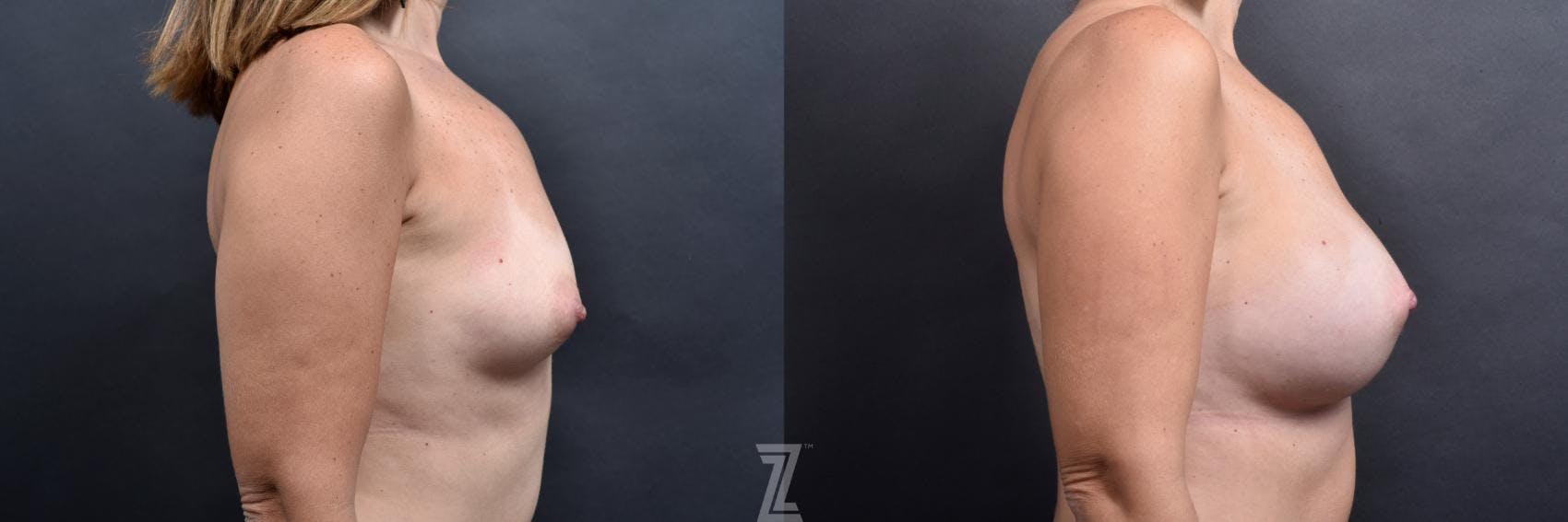 Breast Augmentation Before & After Gallery - Patient 132790698 - Image 5