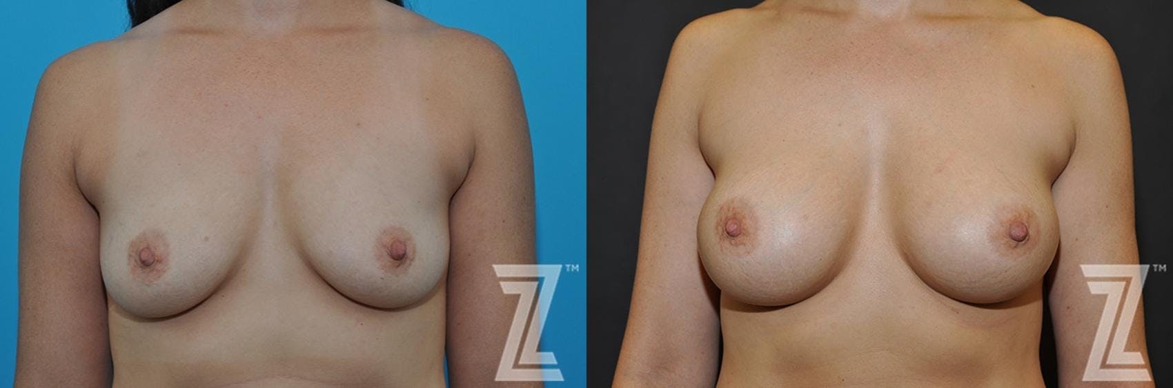Breast Augmentation Before & After Gallery - Patient 132790701 - Image 1