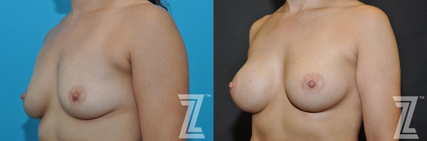 Breast Augmentation Before & After Gallery - Patient 132790701 - Image 2