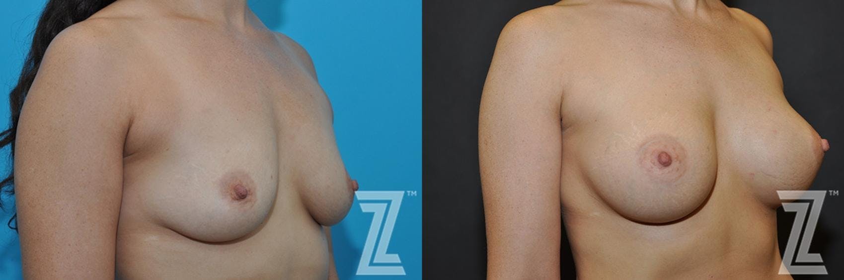 Breast Augmentation Before & After Gallery - Patient 132790701 - Image 4