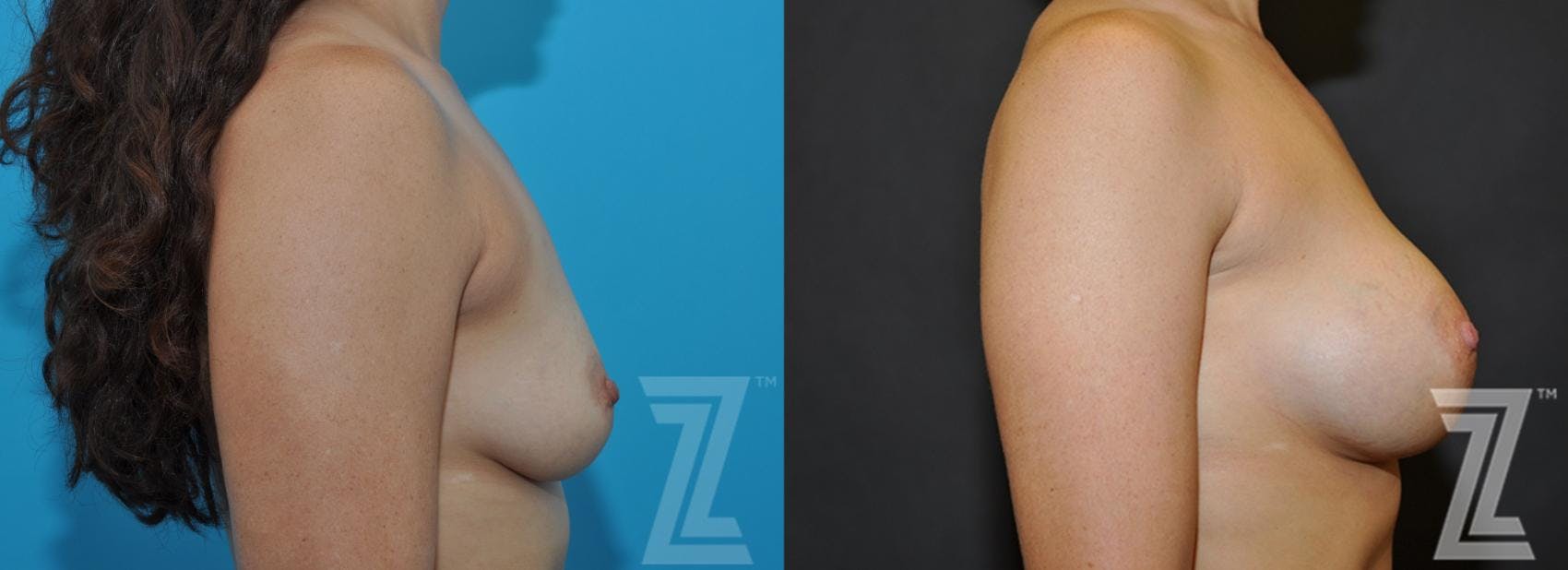 Breast Augmentation Before & After Gallery - Patient 132790701 - Image 5