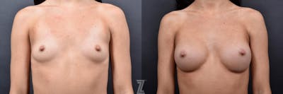 Austin Bilateral view of 24 year old woman 6 month post op with Silicone Implants with Cohesive Silicone Gel - Dr. Rocco Piazza - The Piazza Center