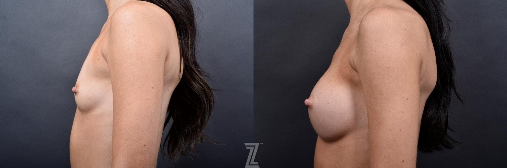 Breast Augmentation Before & After Gallery - Patient 132790703 - Image 3