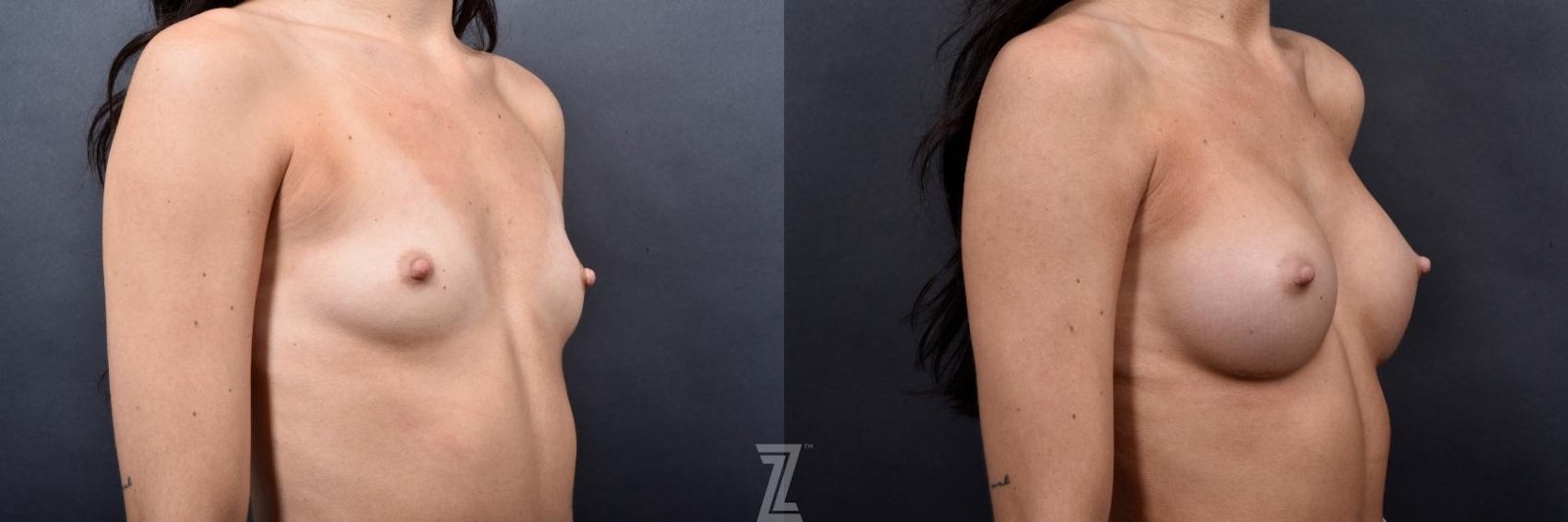Austin Oblique view of 24 year old woman 6 month post op with Silicone Implants with Cohesive Silicone Gel - Dr. Rocco Piazza - The Piazza Center