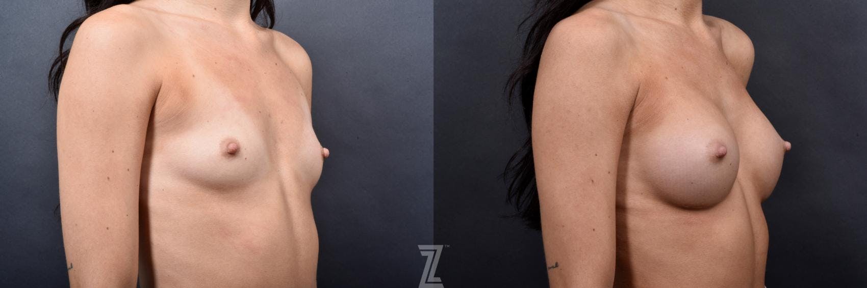 Breast Augmentation Before & After Gallery - Patient 132790703 - Image 4
