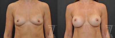 Austin Frontal view before & after images of 32-year-old mother of two 6 month post op breast augmentation - The Piazza Center - The Piazza Center