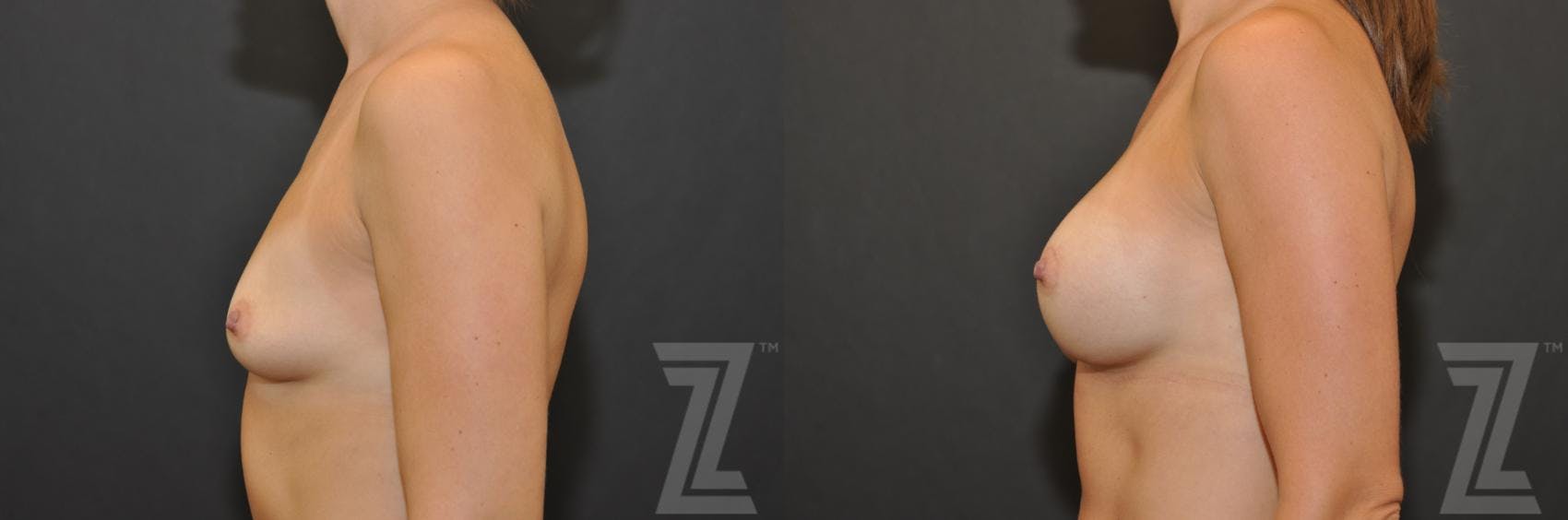 Breast Augmentation Before & After Gallery - Patient 132790705 - Image 2