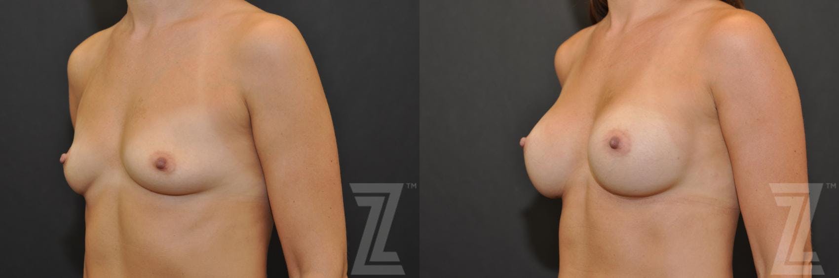 Breast Augmentation Before & After Gallery - Patient 132790705 - Image 3