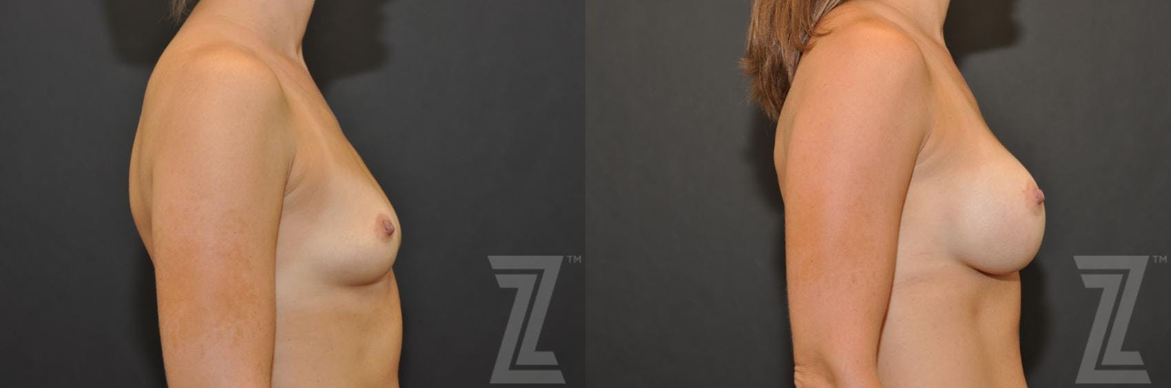 Breast Augmentation Before & After Gallery - Patient 132790705 - Image 4