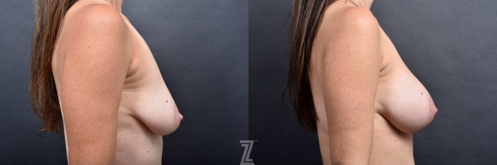 Breast Augmentation Before & After Gallery - Patient 132790706 - Image 5