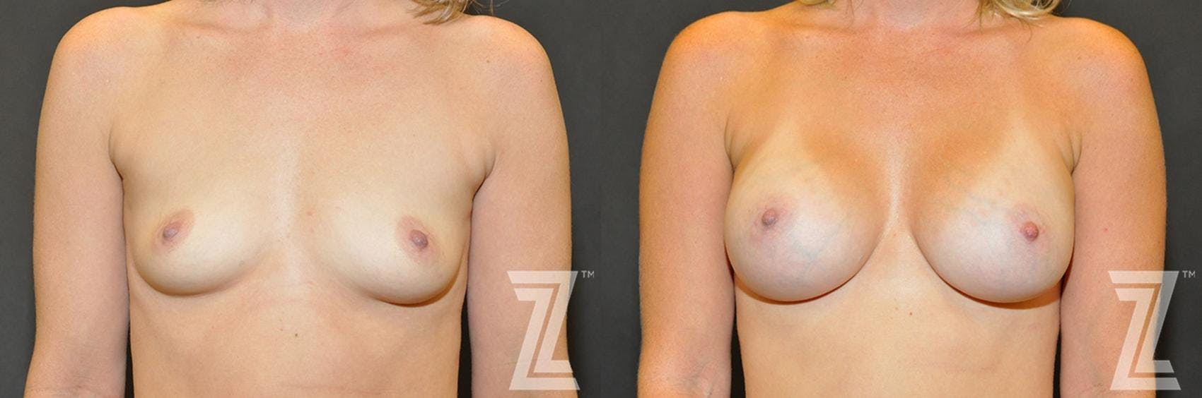 Breast Augmentation Before & After Gallery - Patient 132790708 - Image 1