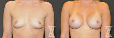 Austin Frontal view before & after images of 35-year-old mother of two 8 month post op breast augmentation - Dr. Rocco Piazza - The Piazza Center