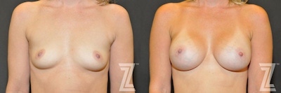 Breast Augmentation Before & After Gallery - Patient 132790708 - Image 1