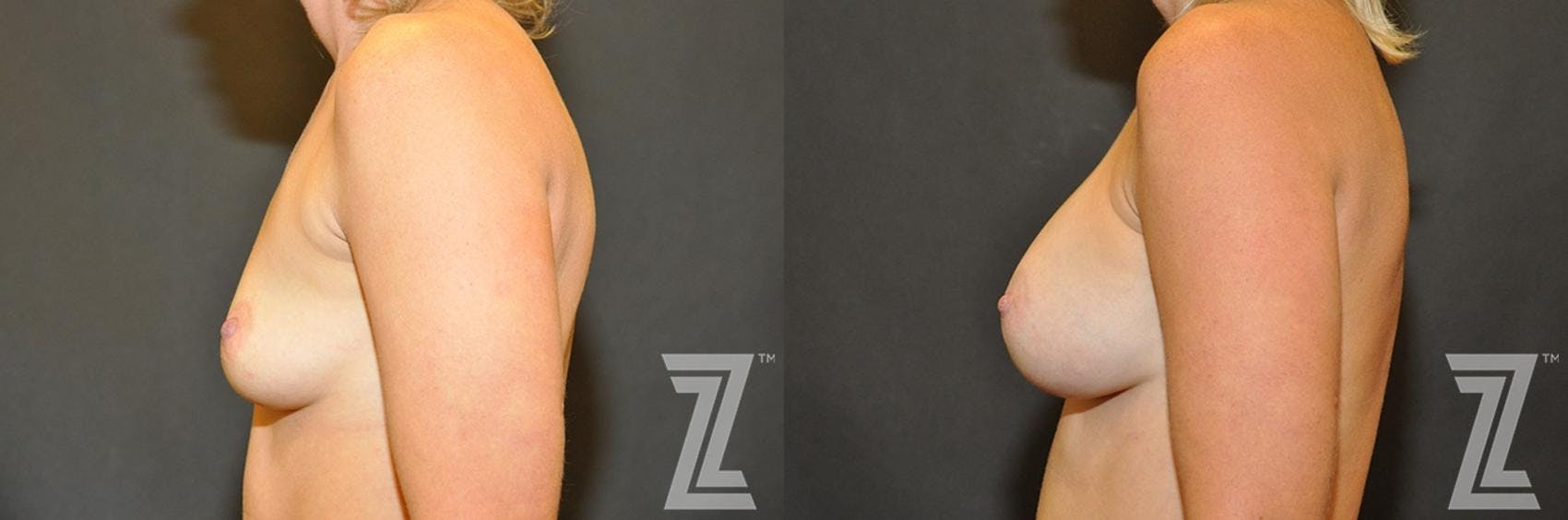 Breast Augmentation Before & After Gallery - Patient 132790708 - Image 3