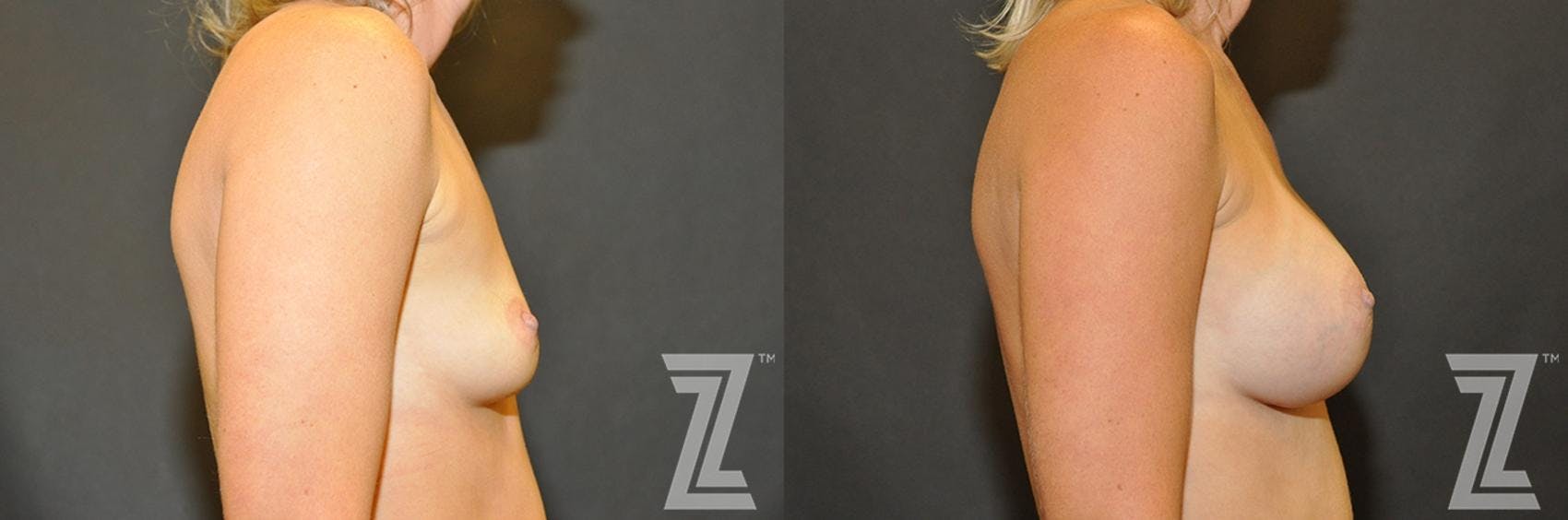 Breast Augmentation Before & After Gallery - Patient 132790708 - Image 5
