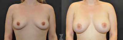 Breast Augmentation Before & After Gallery - Patient 132790712 - Image 1