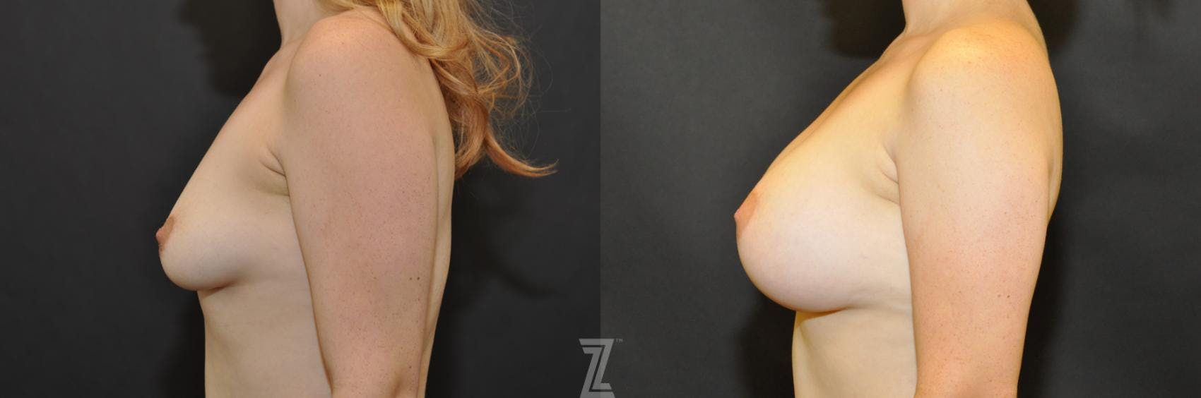 Breast Augmentation Before & After Gallery - Patient 132790712 - Image 3