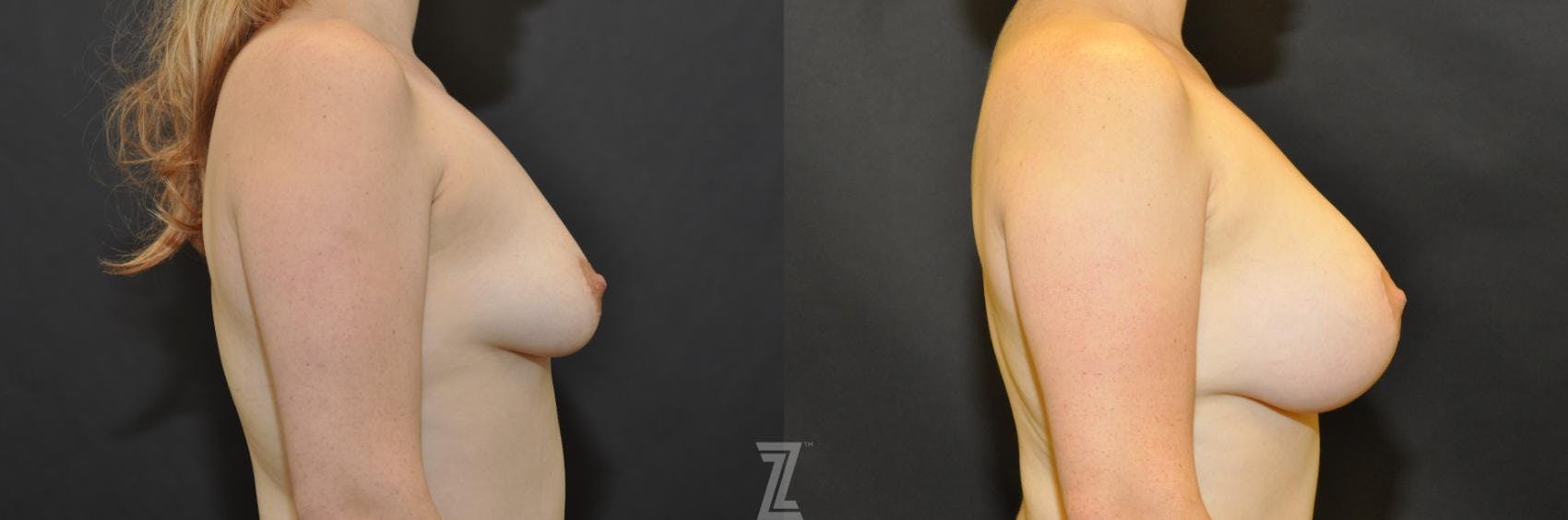 Breast Augmentation Before & After Gallery - Patient 132790712 - Image 4