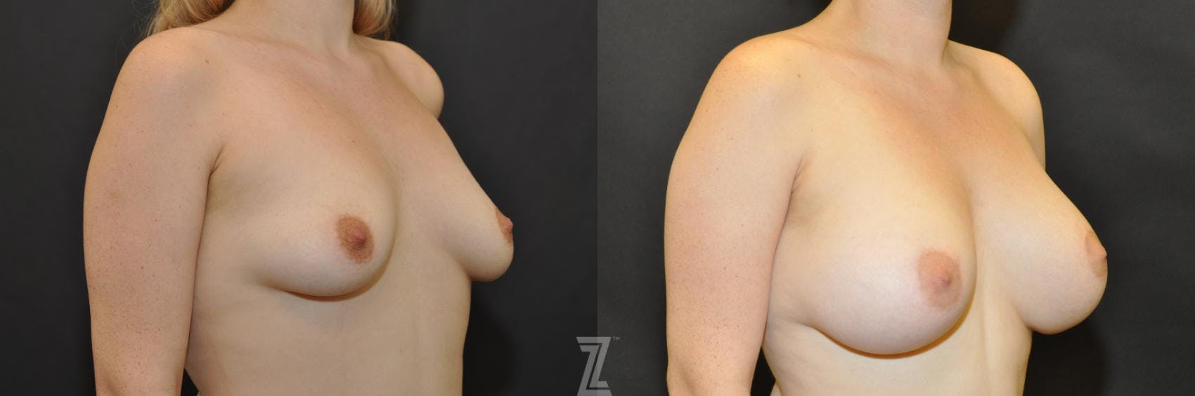 Breast Augmentation Before & After Gallery - Patient 132790712 - Image 5