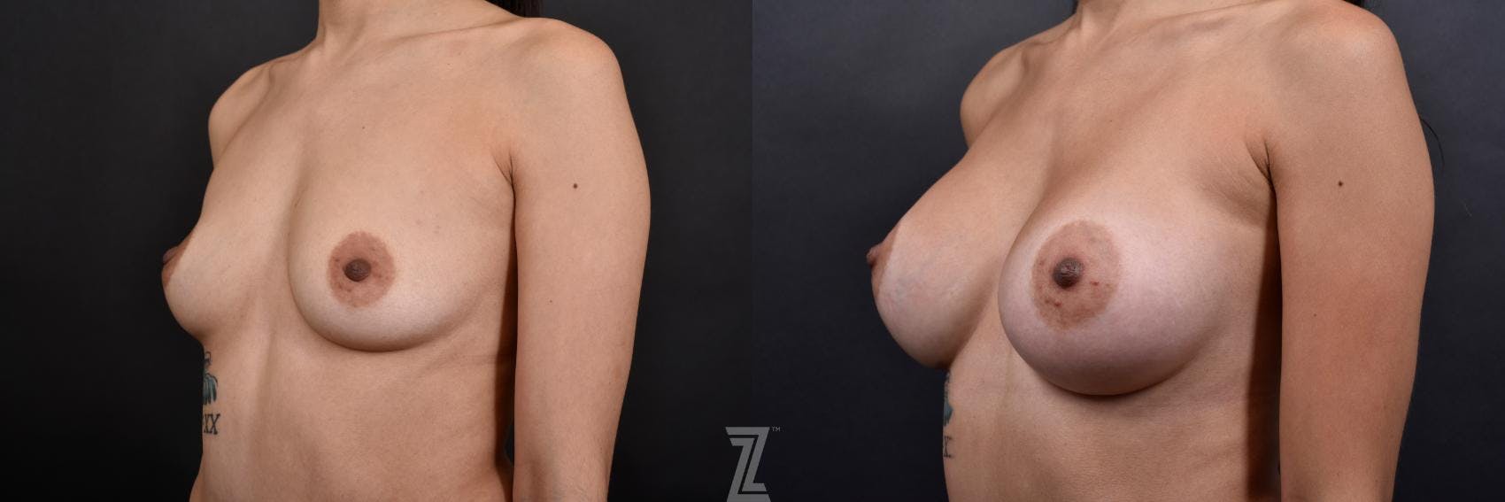 Breast Augmentation Before & After Gallery - Patient 132790713 - Image 2
